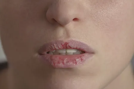 Your Skin - Woman - Dry Lips